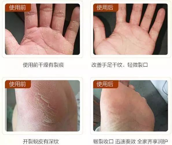 冬天手脚粗糙开裂小妙招,冬季手脚干裂怎么快速修复