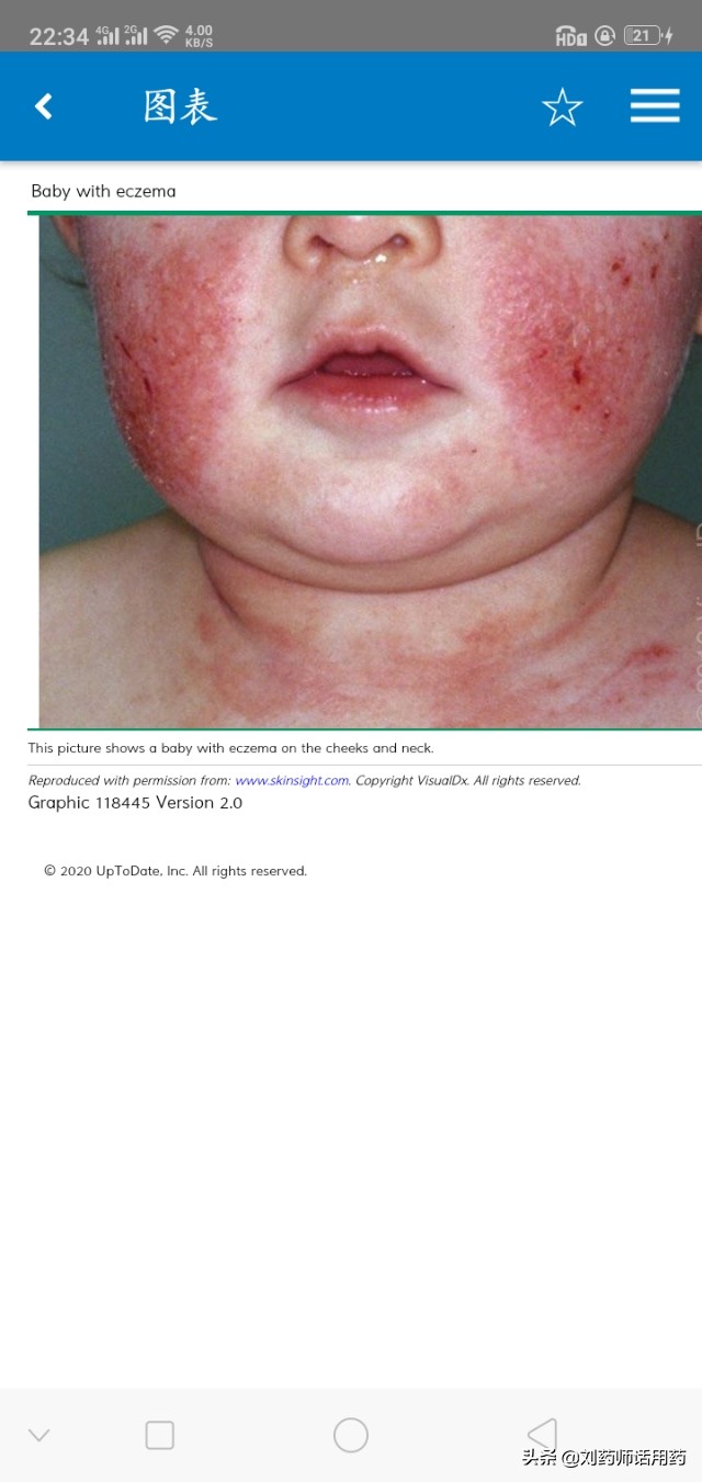 湿疹是皮肤太干还是太湿,湿疹是因为身体有湿热吗