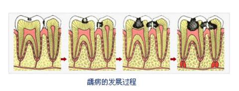 小小年纪就蛀牙是什么原因,小小的蛀牙