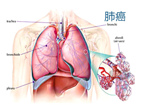 原发性支气管肺癌发病与病因病机,多原发性肺癌的预后