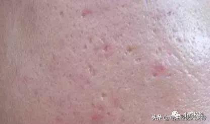 祛痘印最好的方法目前最有效,祛痘印的东西怎么用