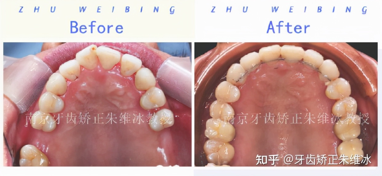 南京牙齿矫正龅牙前突要多少钱,36岁牙周不好龅牙能整吗