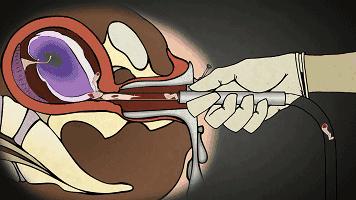25岁女子做无痛人流,未婚女孩六年做了17次人流