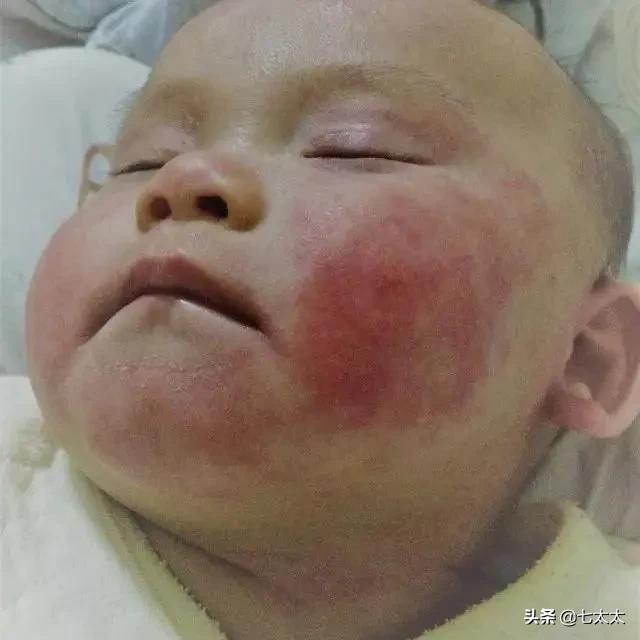 以「湿疹」之名的智商税，除了「大头娃娃」还有什么？