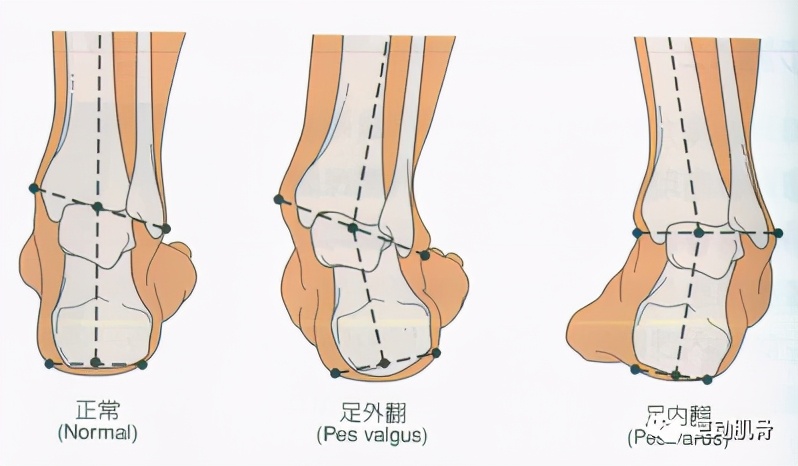 骨折21天自行拆石膏,骨折保守治疗打石膏是愈合得快吗