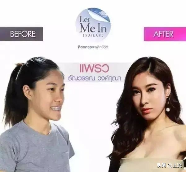 泰国流行戴牙套,泰国最近很火的牙套