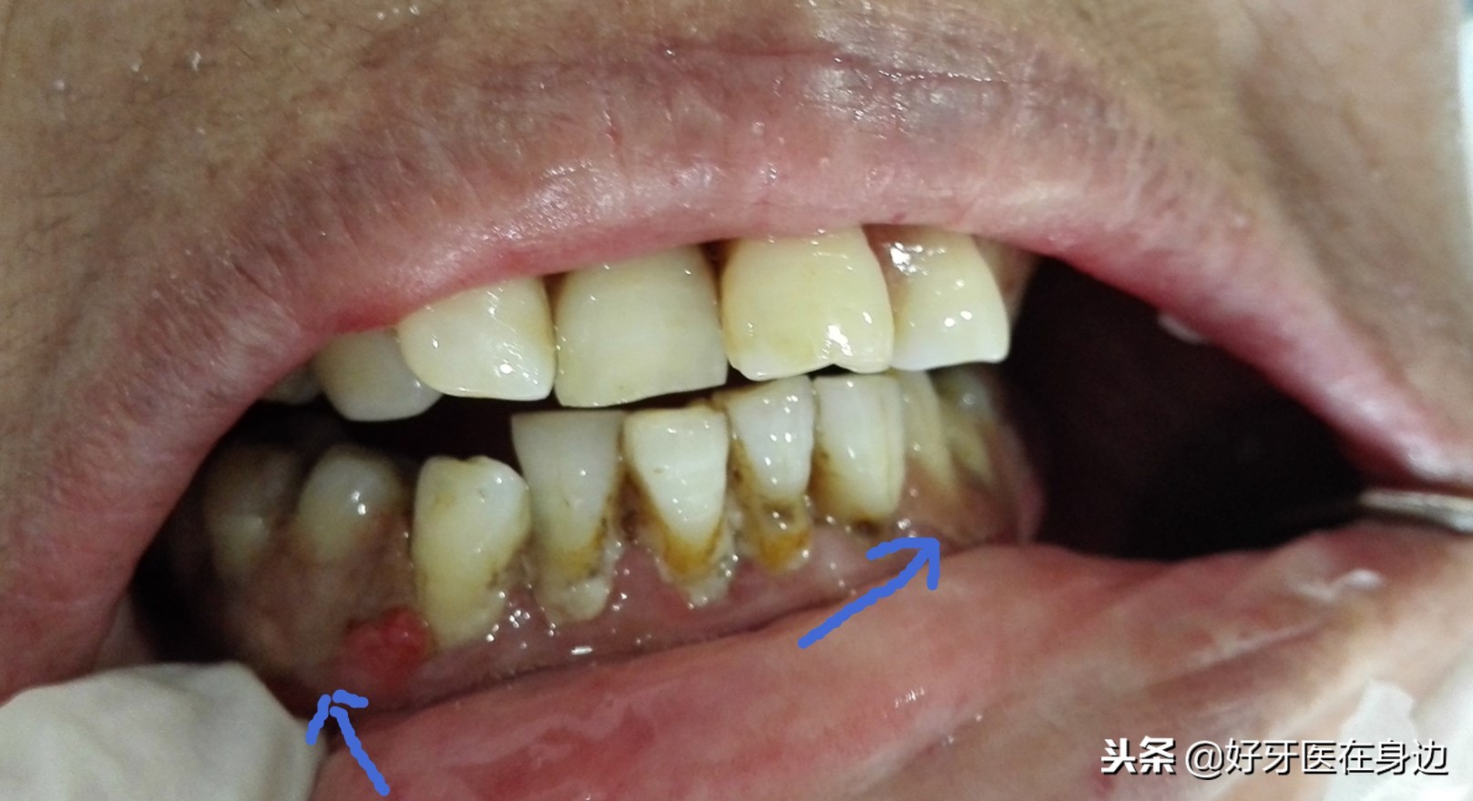 别再这样镶牙啦，孝顺就转给父母看看吧！