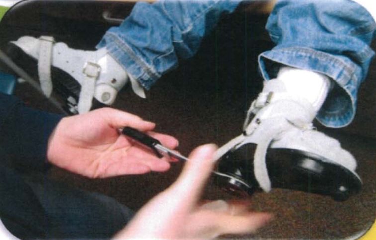 马蹄足畸形矫正案例,足踝部畸形矫正