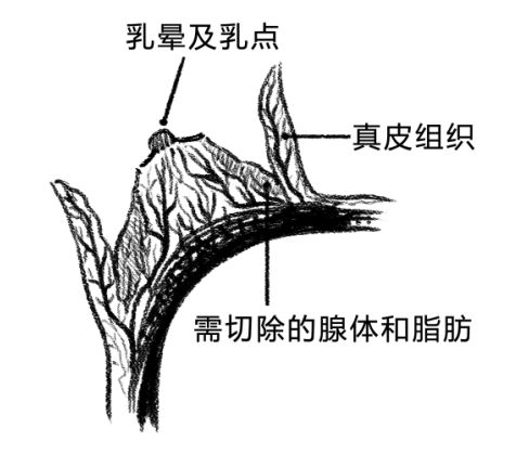 乳房过大可以做手术去除吗,乳房太大做缩乳手术有危险吗