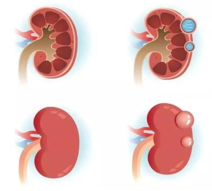 肾囊肿无创手术治疗全过程,发现肾囊肿吃什么药消掉