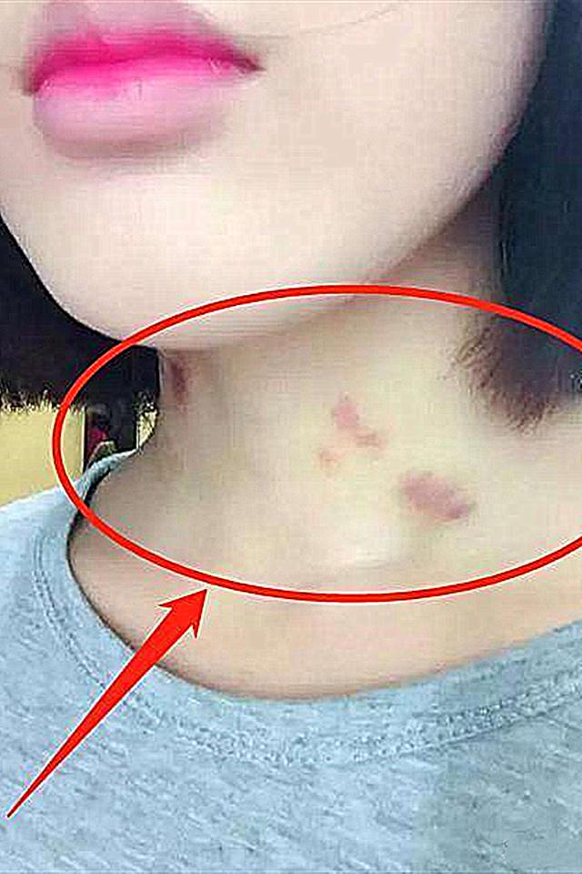 12岁女孩脖子印有“草莓”，家人痛心逼问，孩子的回答令人深思