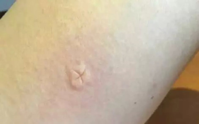 夏天蚊子为啥总喜欢咬我,蚊子为什么总喜欢盯着一个人咬