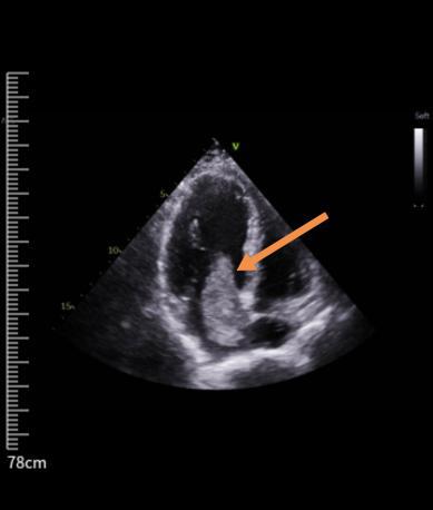 心房粘液瘤,心脏粘液瘤左心房长东西