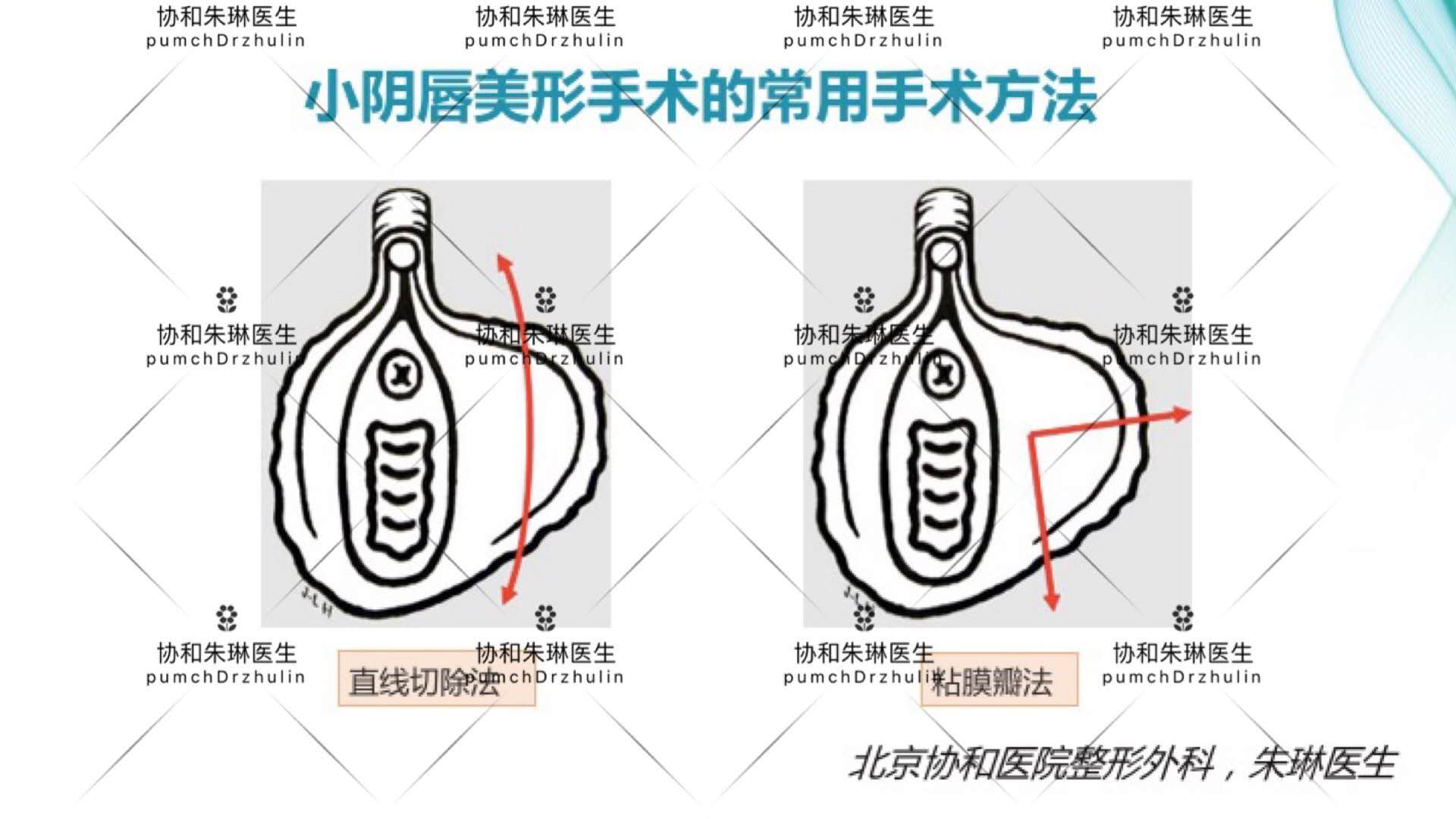 简单粗暴的小阴唇“一刀切”，为什么坚决不能做？
