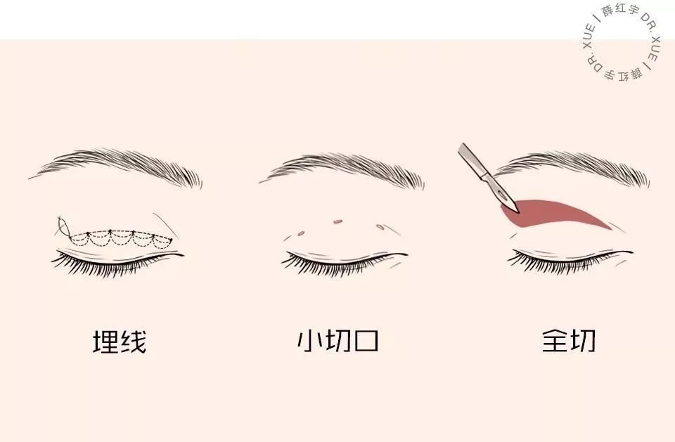 那些要求双眼皮术后效果立竿见影的姑娘们，后来怎么样了？