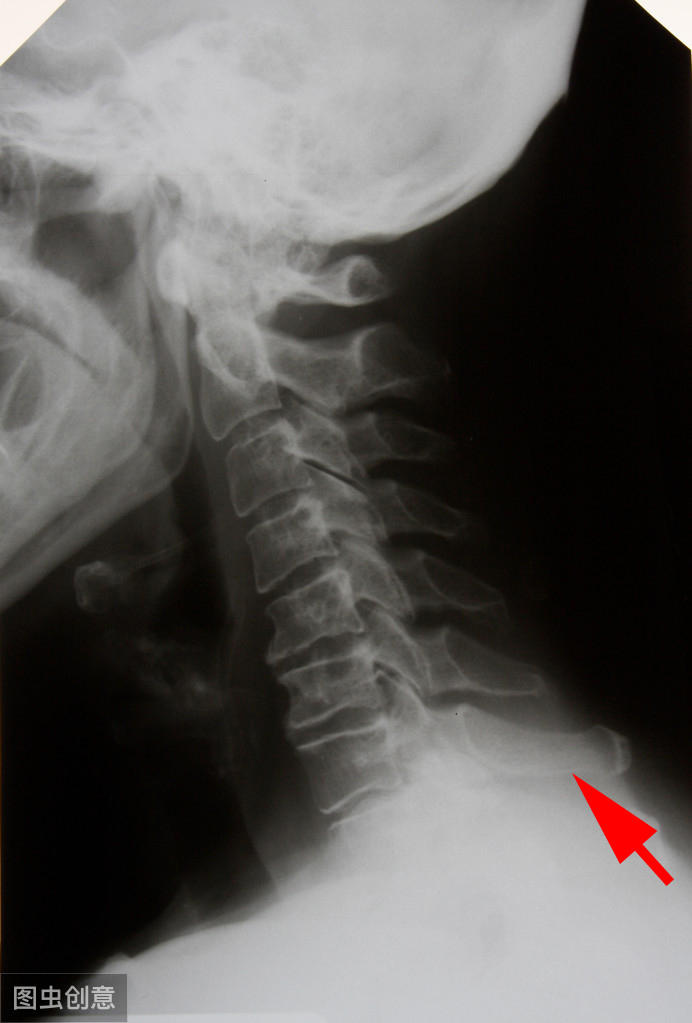 脖子后面鼓个小包怎么回事,颈椎病后面脖子有硬块
