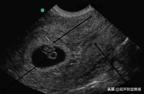 内见卵黄囊,卵黄囊肿瘤