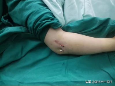 小孩子骨折和成人骨折有什么区别,小孩常见骨折类型