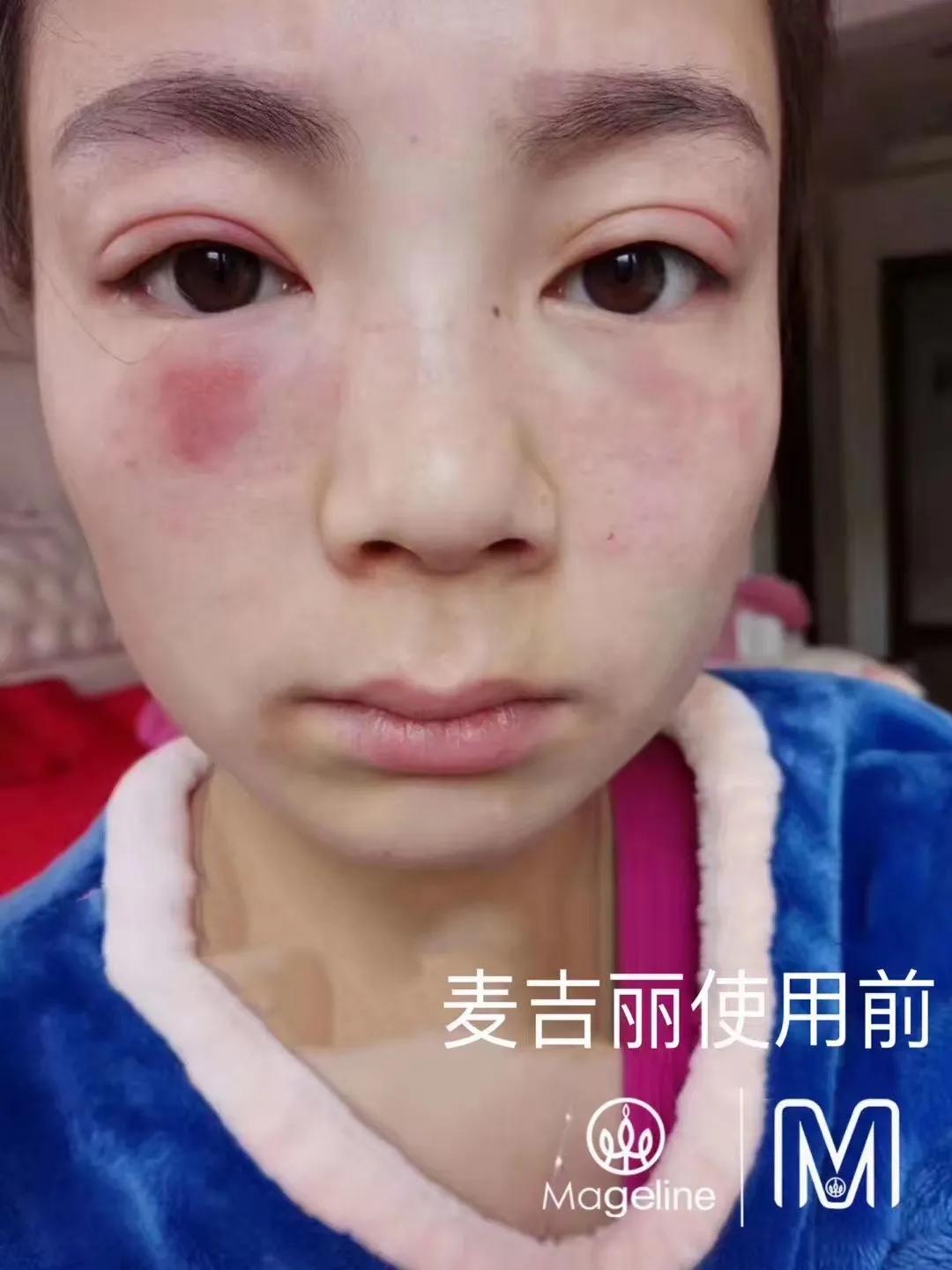 甜甜专业祛斑祛痘,甜甜祛斑直播间