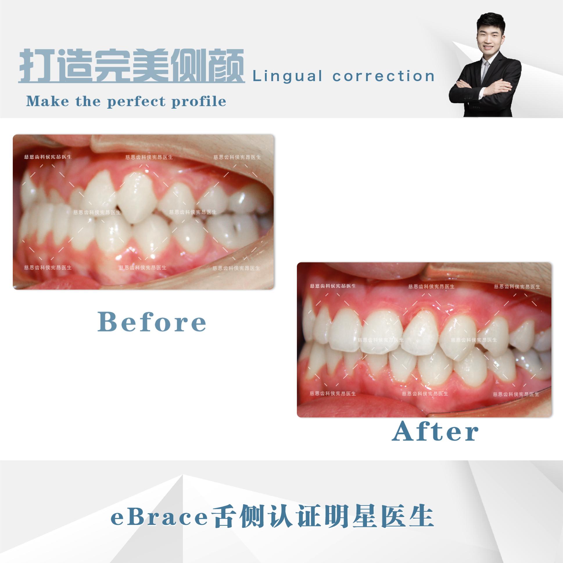 牙齿地包天矫正前后脸型对比,牙齿地包天矫正最低价多少钱
