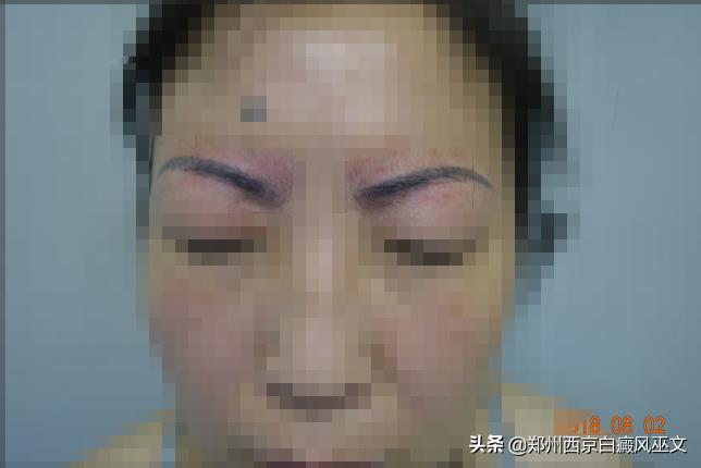 白癜风早期分型图,白癜风的病例描述