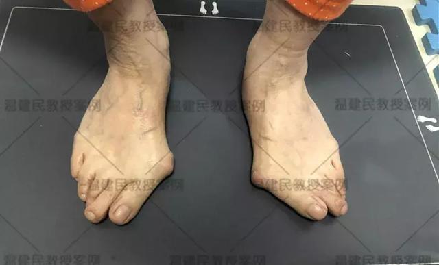 大脚骨怎么做手术好得快,什么样的大脚骨需要手术