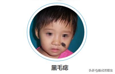 黑毛痣容易出现恶化病变吗