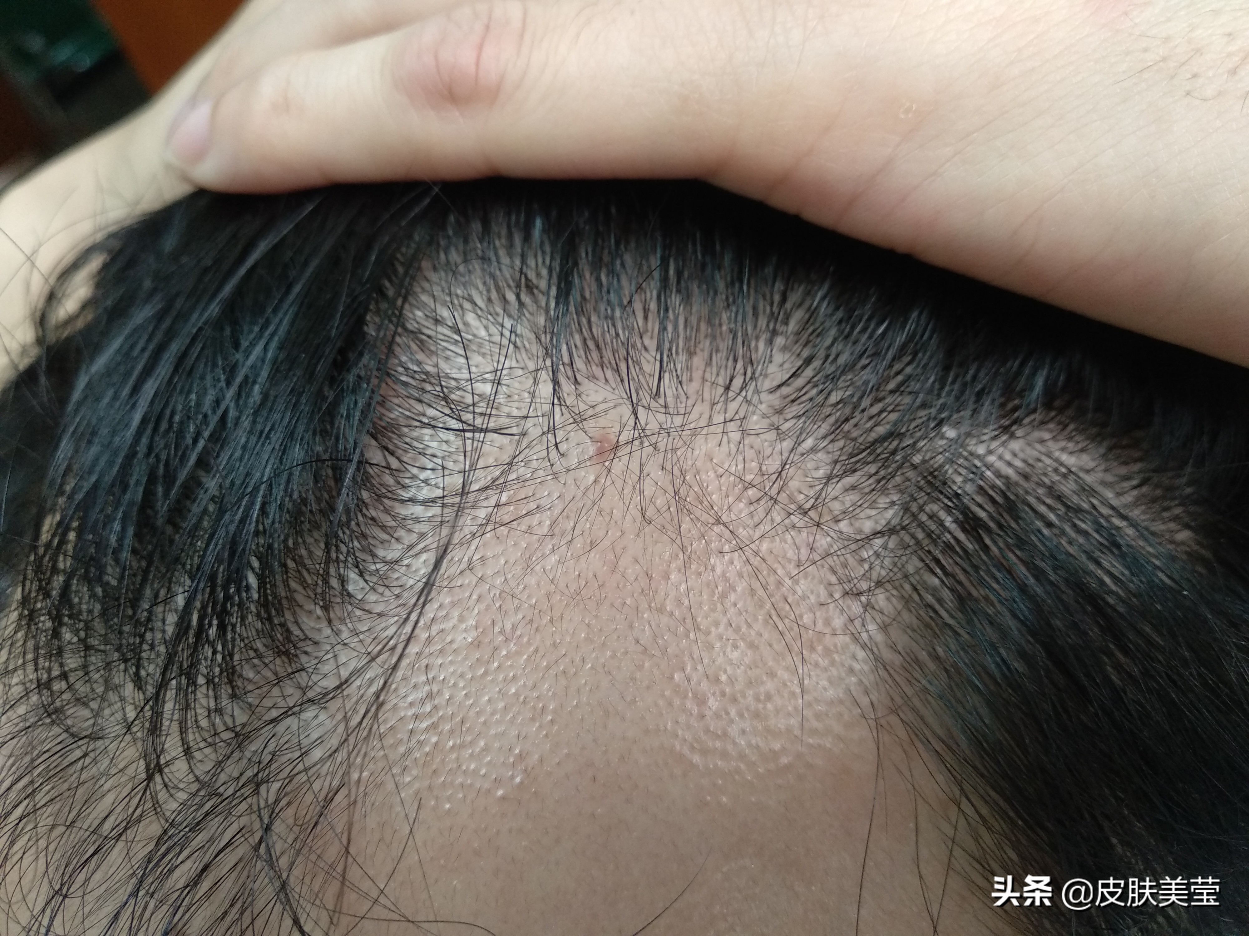 脂溢性脱发不好治,维生素b6能治脂溢性脱发有效果吗