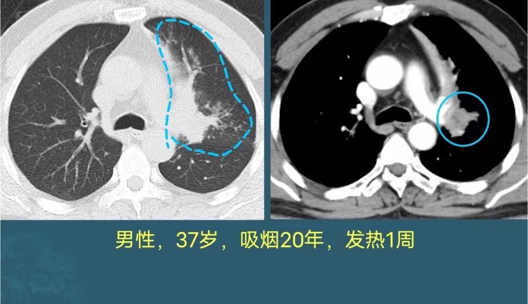 年纪大了得了肺癌怎么办,年纪轻轻得了肺癌怎么办