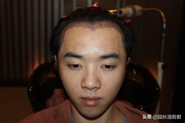 华晨宇回应植发,曝华晨宇植发真的假的
