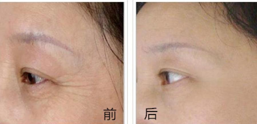 注射玻尿酸和肉毒素除皱皮肤紫红,肉毒素除皱后可以做玻尿酸填充吗