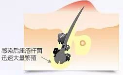 痘痘不去挤变疤痕疙瘩,痘痘不去挤变黑了怎么办