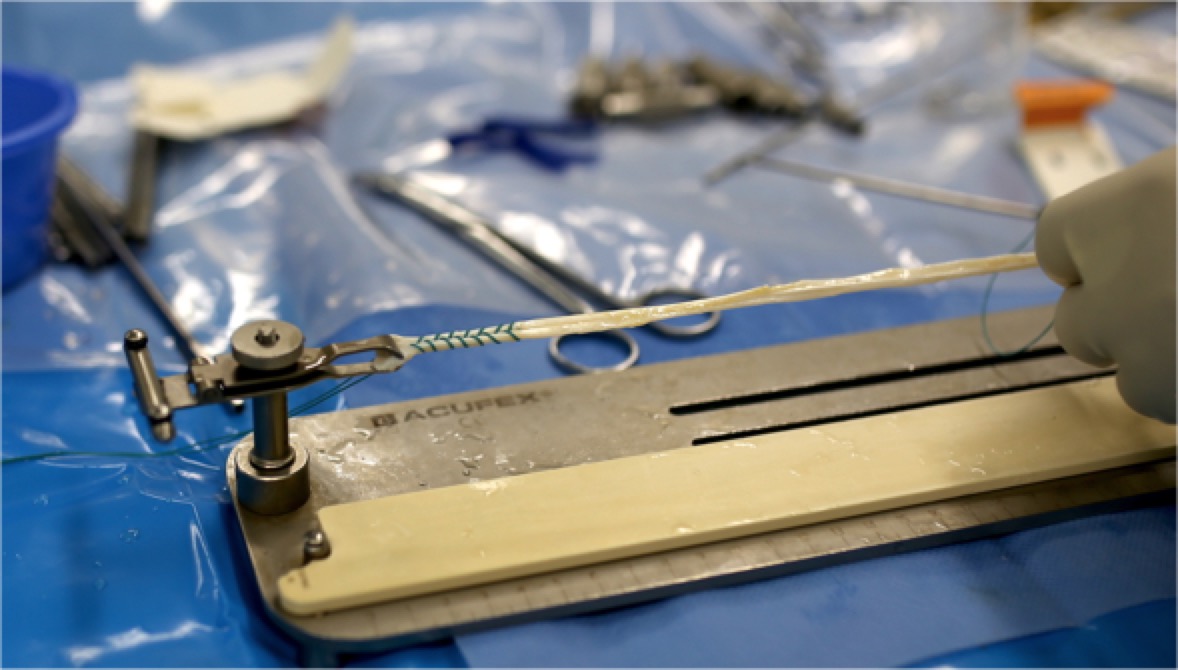 前叉重建单束可以满足运动要求么,前叉重建有几个切口