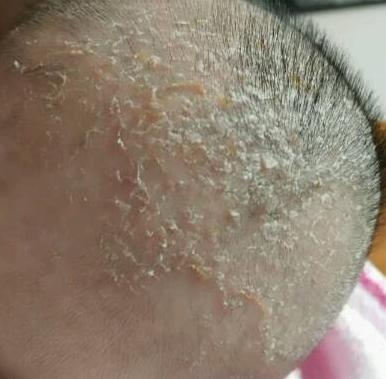 素东方科普|宝宝头上有头垢如何护理？