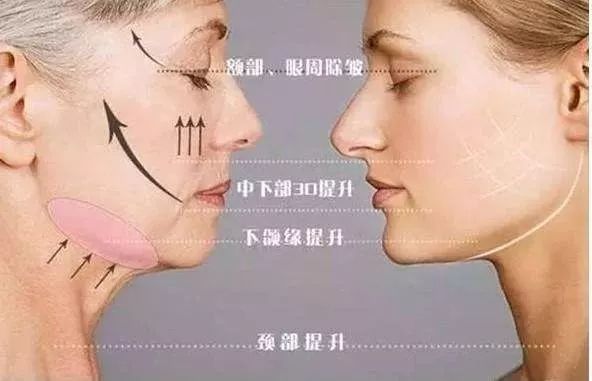 线雕热玛吉拉皮超声刀的区别,热玛吉超声刀线雕后遗症有多严重