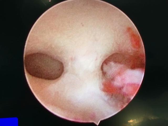 宫腔镜腹腔镜动画,宫腔镜和腹腔镜检查全过程