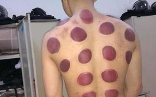 拔罐黑是有瘀血吗,拔罐要怎么才能更好拔出黑印