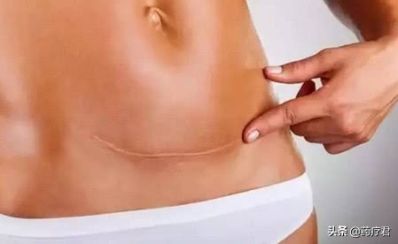 剖腹产后的“伤口”多久才能愈合?答案可能和你想象的不一样