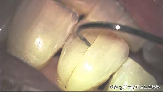 牙隐裂必须要戴牙套吗,牙隐裂需要补牙吗