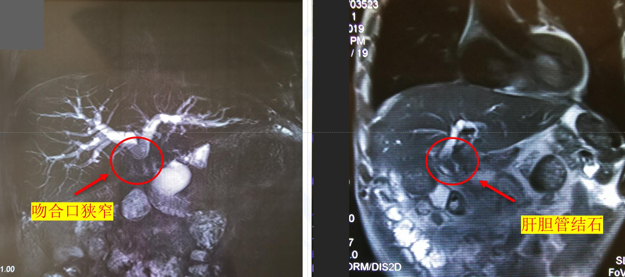 胆肠吻合术后吻合口狭窄梗阻咋办,胆肠吻合术后胆瘘怎么处理