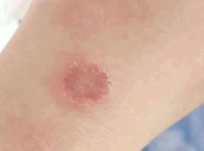 毛真菌感染治疗方法,毛孩子反复感冒怎么办