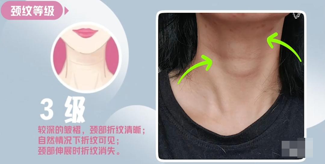 嗨体颈纹针使用方法,嗨体颈纹注射全过程