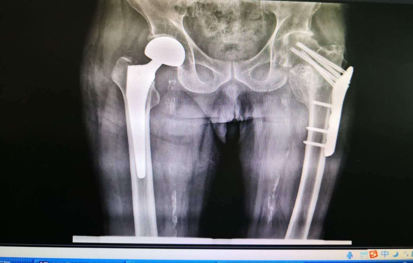 脑血栓遭罪的视频,家有病人要注意什么