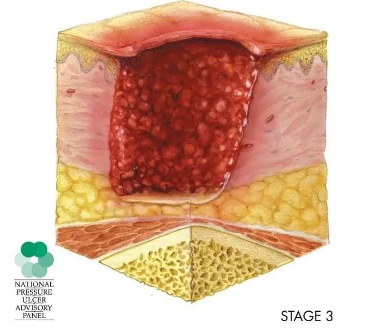 压疮情况要分期,严重危害需知道