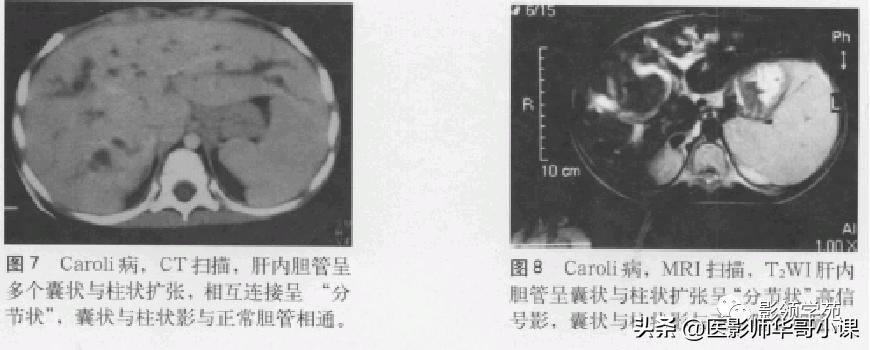 胆总管变异,胆胰管解剖