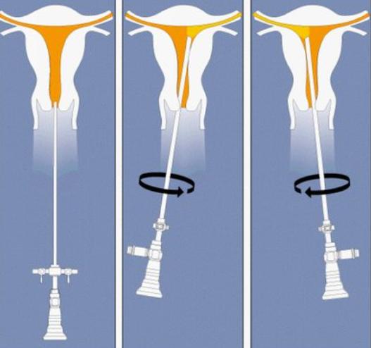 两姐妹同时查出恶性肿瘤事件,母女一起得癌症