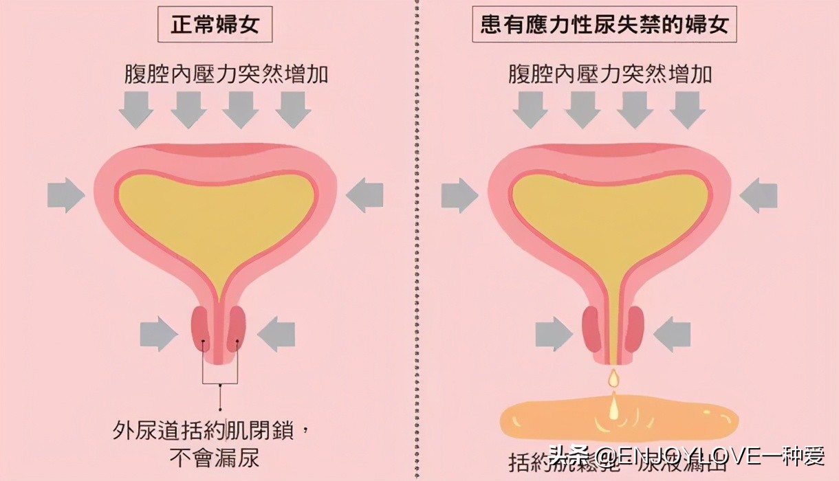 产后漏尿,都是盆底肌损伤惹的祸