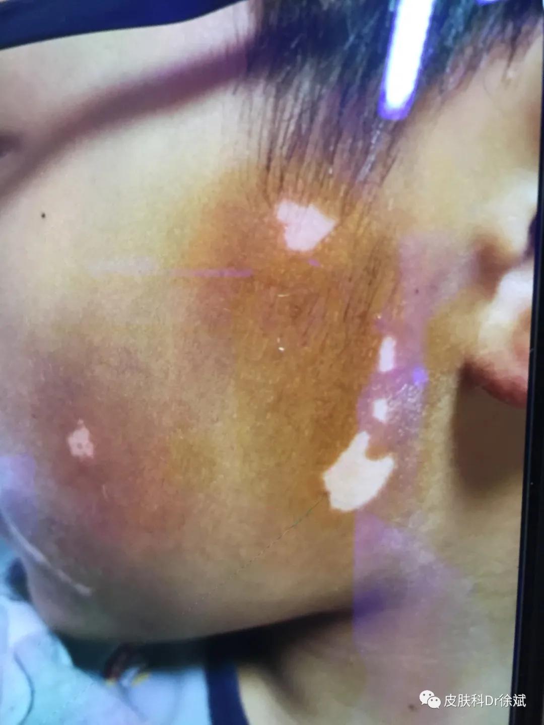 儿童治疗白癜风需要多少钱,uvb治疗白癜风多久见效