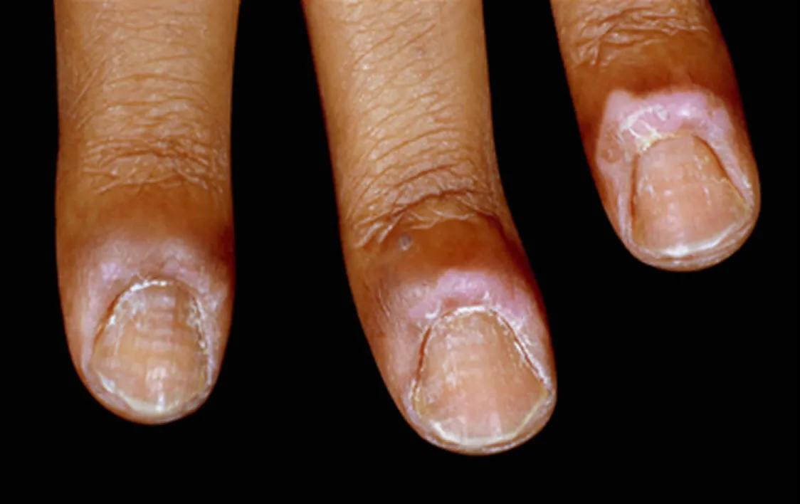 解决甲沟炎比较好的方法,甲沟炎很严重怎么修