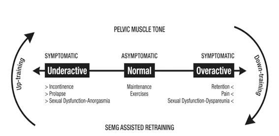 盆底肌高度紧张卡放松训练方法